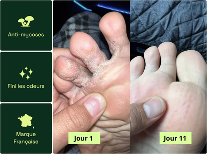 Savon Purifiant Antifongique – Soin Naturel Anti-Mycoses