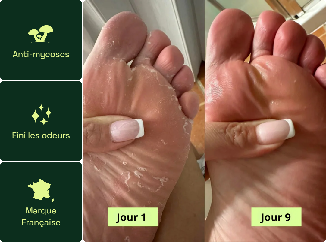 Savon Purifiant Antifongique – Soin Naturel Anti-Mycoses